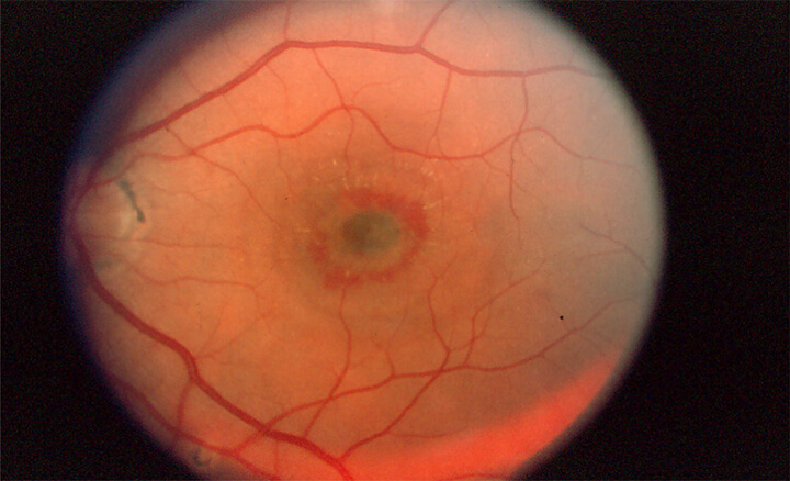 CNV of Histoplasmosis