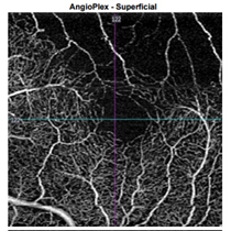 Superficial Angloplex