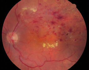 Branch Retinal Vein Occlusion