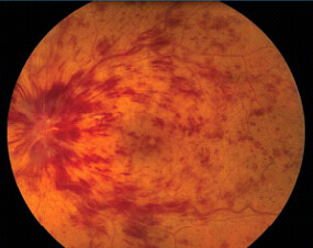 Central Retinal Vein Occlusion