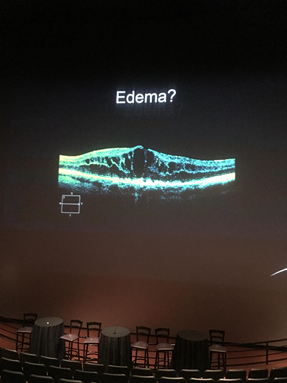 Slide From Edema Talk