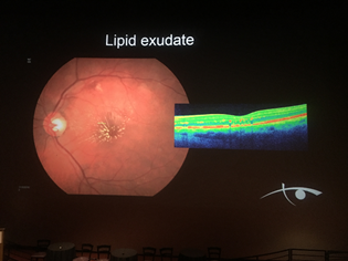 Slide From Lipid Talk