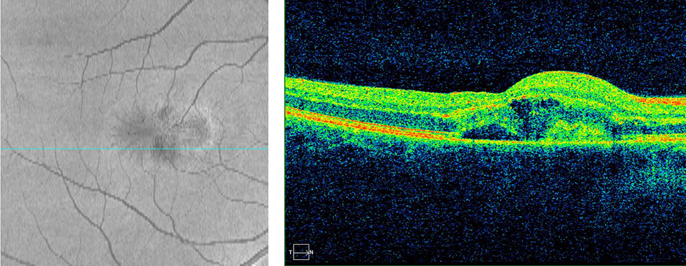 MACULAR CNV WITH HISTO