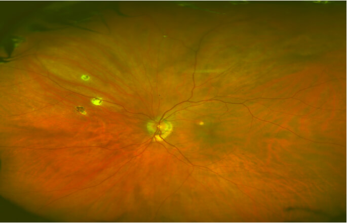 Photo of Histoplasmosis spots on retina