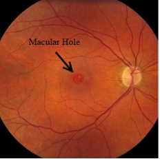 Macular Hole image