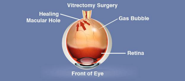 Vitrectomy Surgery Diagram