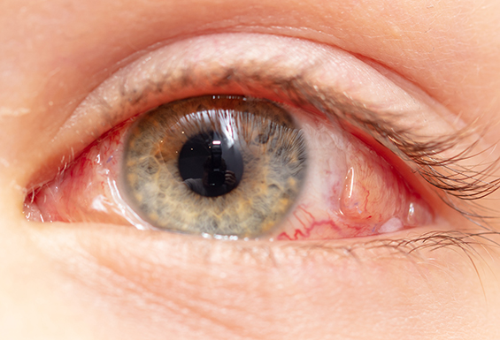 Close Up Eye Before Vitrectomy