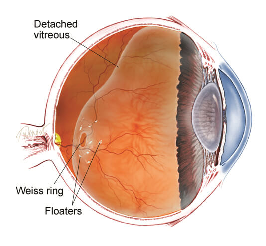 Posterior Vitreous Detachment