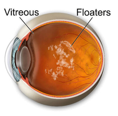 Floaters Diagram