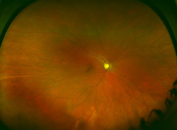 Healthy Retina