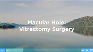 Macular Hole Surgery