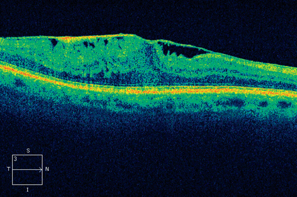 Macular Pucker
