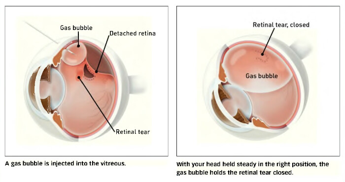 retinal tear vitreous