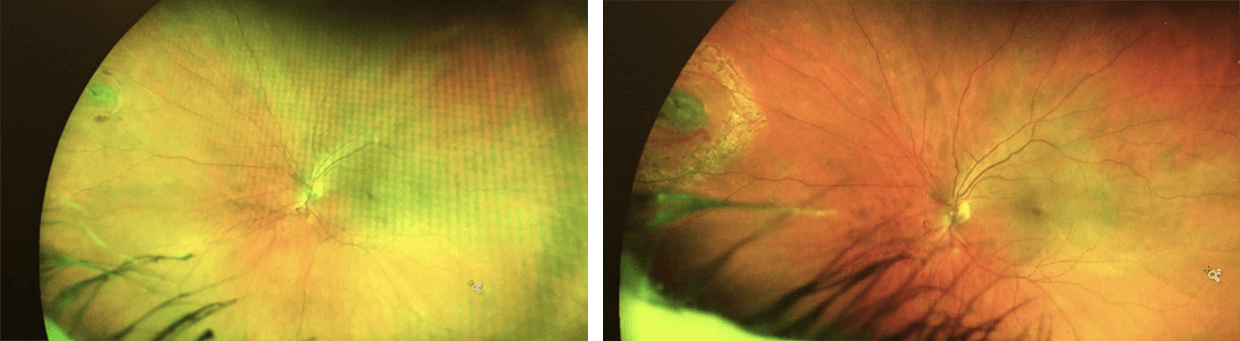 Retinal tear before and after treatment