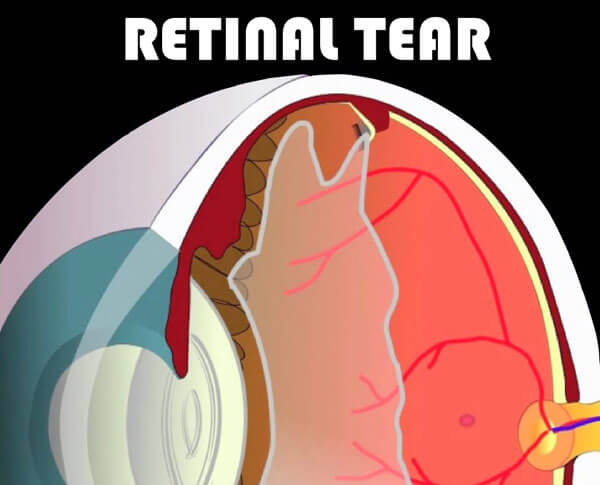 Retinal Tear occuring from Vitreous Detachment