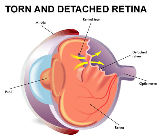 Retinal Detachment: Symptoms & Causes